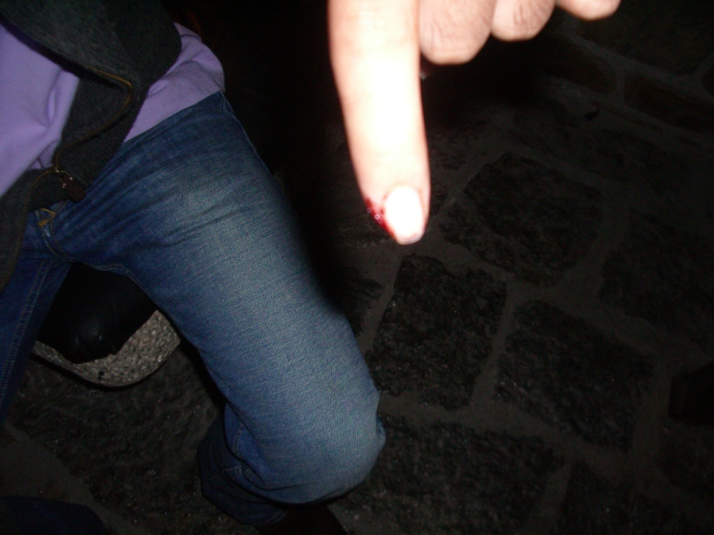 IMGP2012 renaud blessure